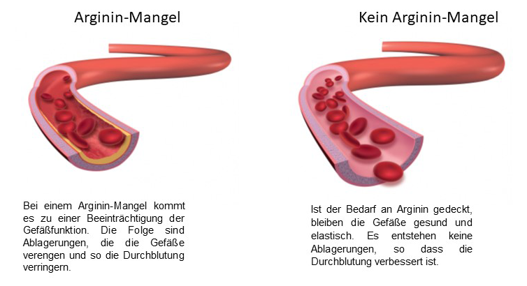 Arginin Mangel Info-Grafik