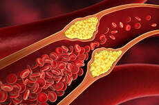 Arteriosklerose (grafische Darstellung)